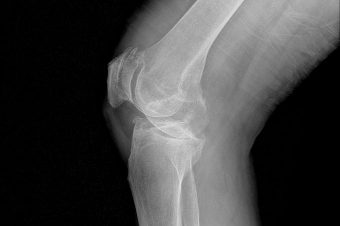 Suffering from knee pain? It could be Osteoarthritis!